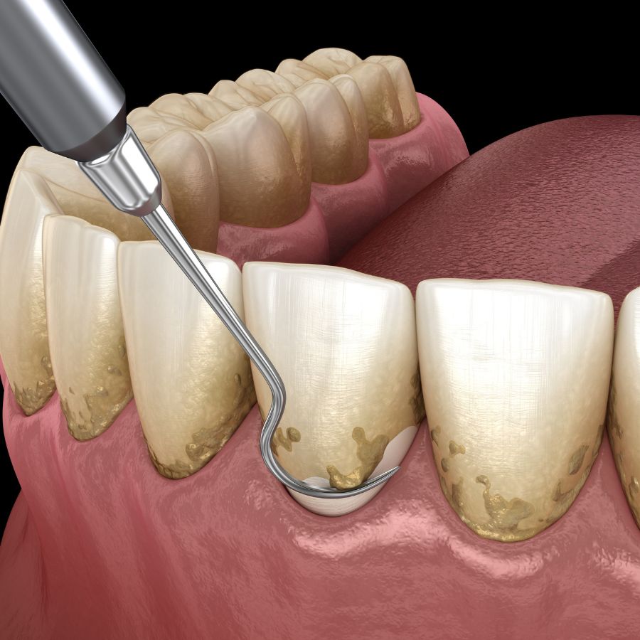 While non-surgical periodontal treatments are effective in tackling the early stages of gum disease, there are situations where these methods may not be enough.