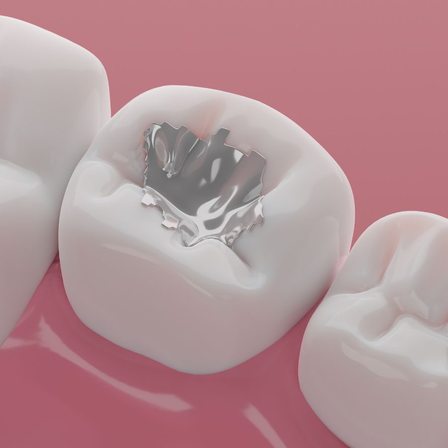 Often, patients at ROC Dental Group choose tooth-colored composite fillings for their aesthetic appeal.