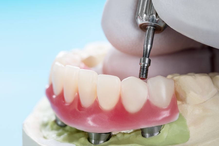 At ROC Dental Group, we’re revolutionizing smiles with our advanced All-On-Four Dental Implants.