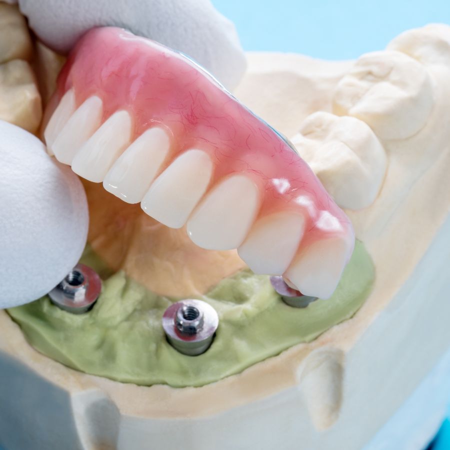 Let’s explore the intricacies of the All-On-Four implant procedure.