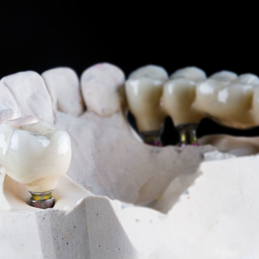 Just as we meticulously craft our dental crowns, we also offer extensive solutions for replacing missing teeth with dental bridges.