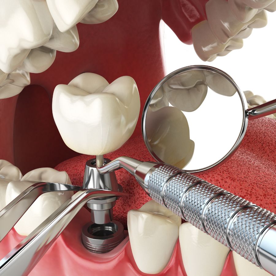 Before moving forward with dental implants, it’s important to determine if you’re an ideal candidate.