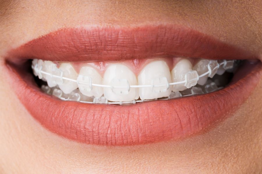 At ROC Dental Group, we specialize in offering clear braces, the discreet and effective solution for your teeth straightening needs.