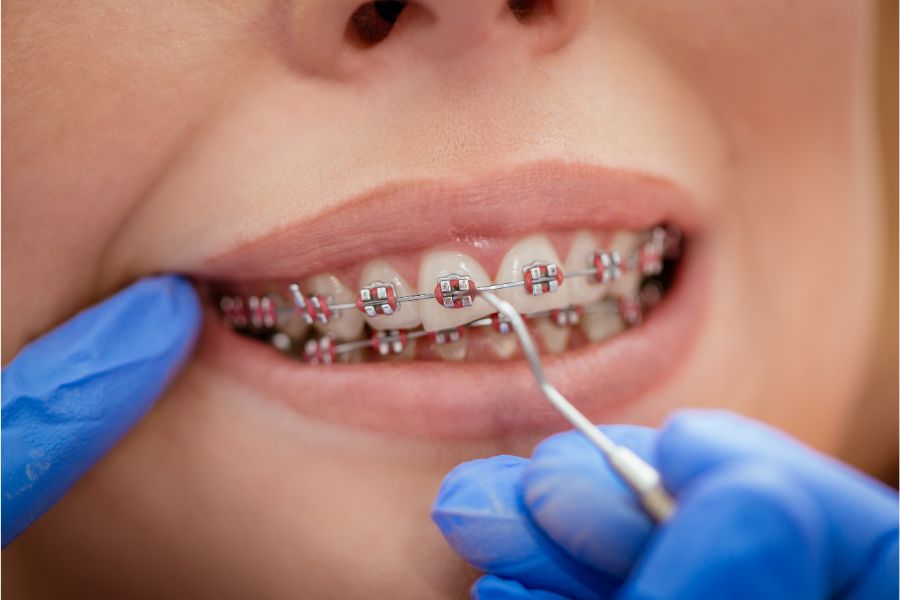 At ROC Dental Group, we are passionate about giving you the smile you’ve always wanted using conventional braces.