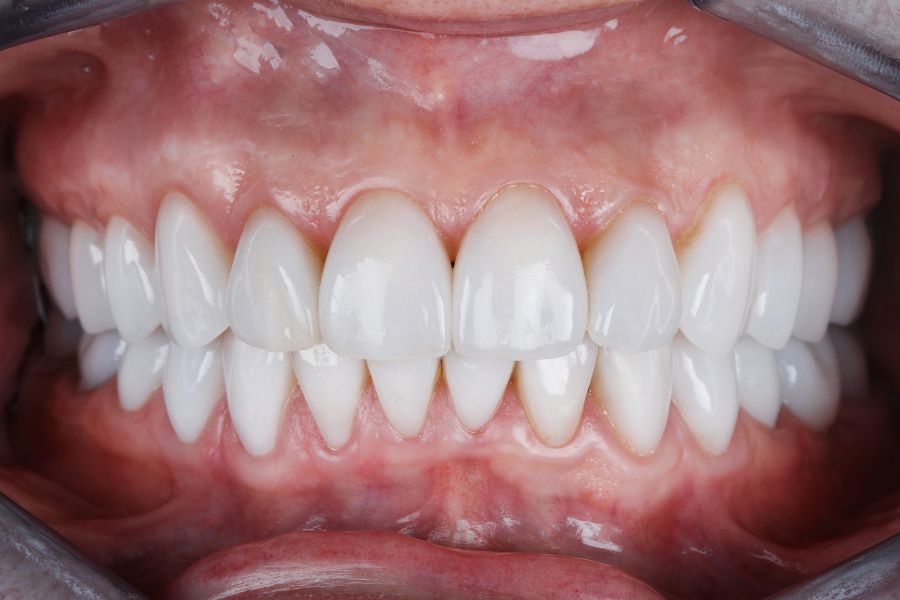 At ROC Dental Group, we’re passionate about transforming smiles with exceptional cosmetic bonding.