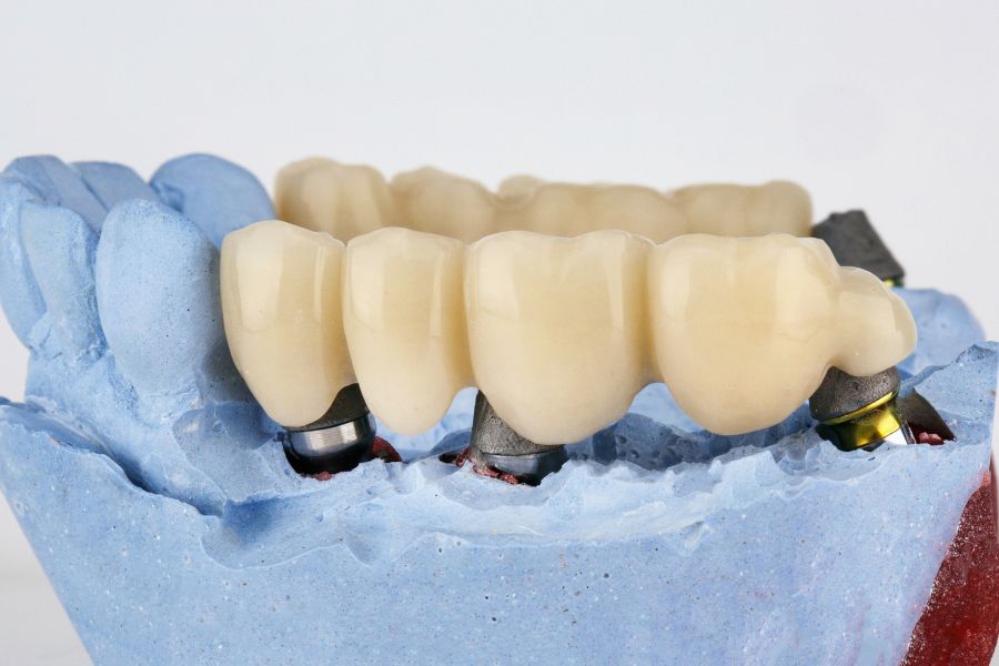 At ROC Dental Group, we’re passionate about restoring your most confident smile with dental crowns and bridges that are crafted to match your natural teeth perfectly.