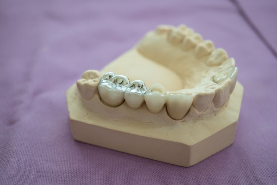 At ROC Dental Group, we offer top-tier dental fillings, be they composite or amalgam, customized to your specific needs and aesthetics.