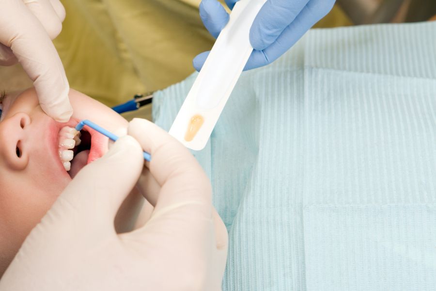 At ROC Dental Group, we provide top-tier fluoride treatments essential for preventative dental care.