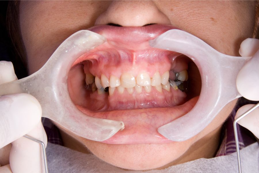 At ROC Dental Group, we craft personalized treatment plans to provide full mouth rehabilitation.