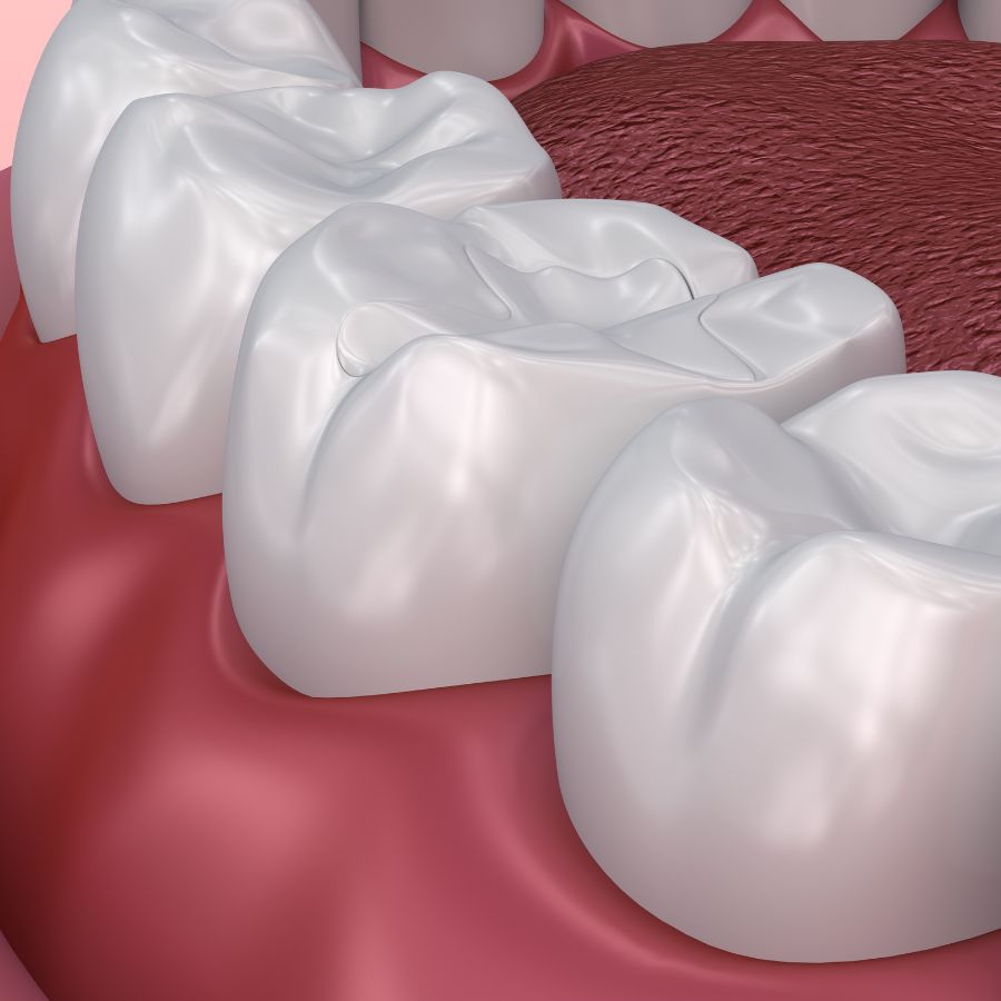 Sealants are truly a game-changer when it comes to cavity prevention.