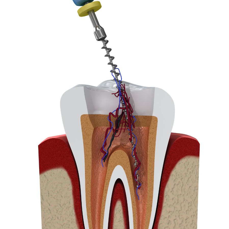 At ROC Dental Group, we're always on the lookout for ways to make your root canal therapy more comfortable.