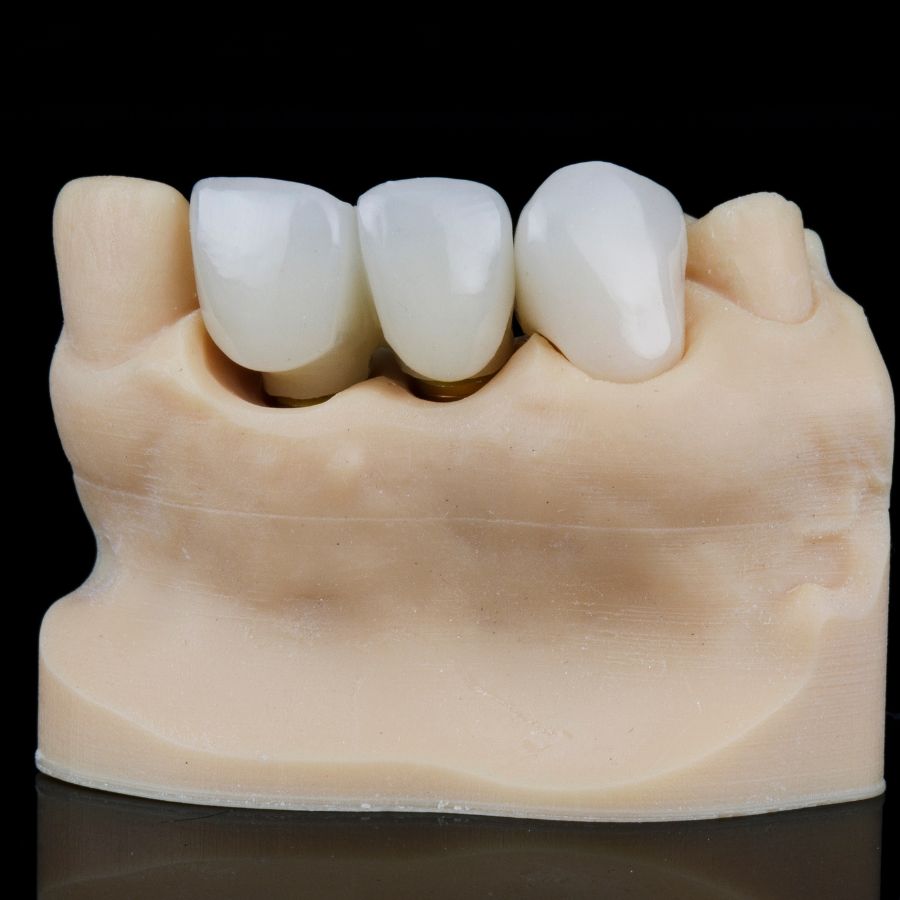 Having understood the meticulous process of crafting porcelain crowns and bridges, let's now explore the procedure for their placement.