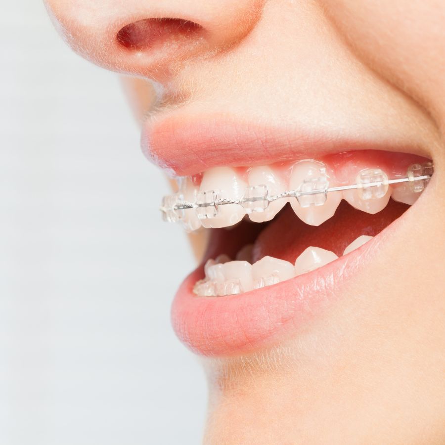 Initiating the journey to a perfect smile, we guide you through every step of getting and adjusting clear braces.