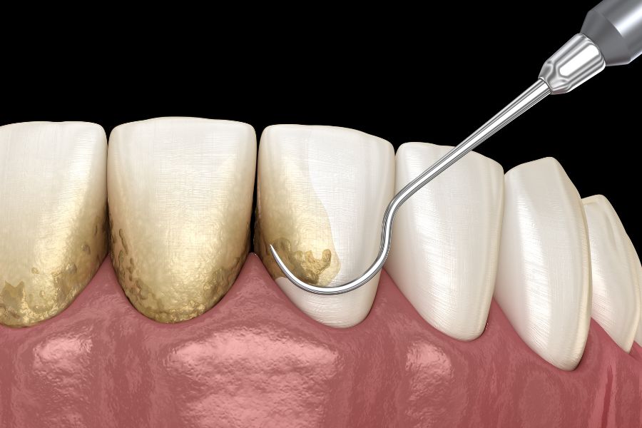 At ROC Dental Group, we're experts in scaling and root planing, vital services designed to combat gum disease and support your overall oral health.