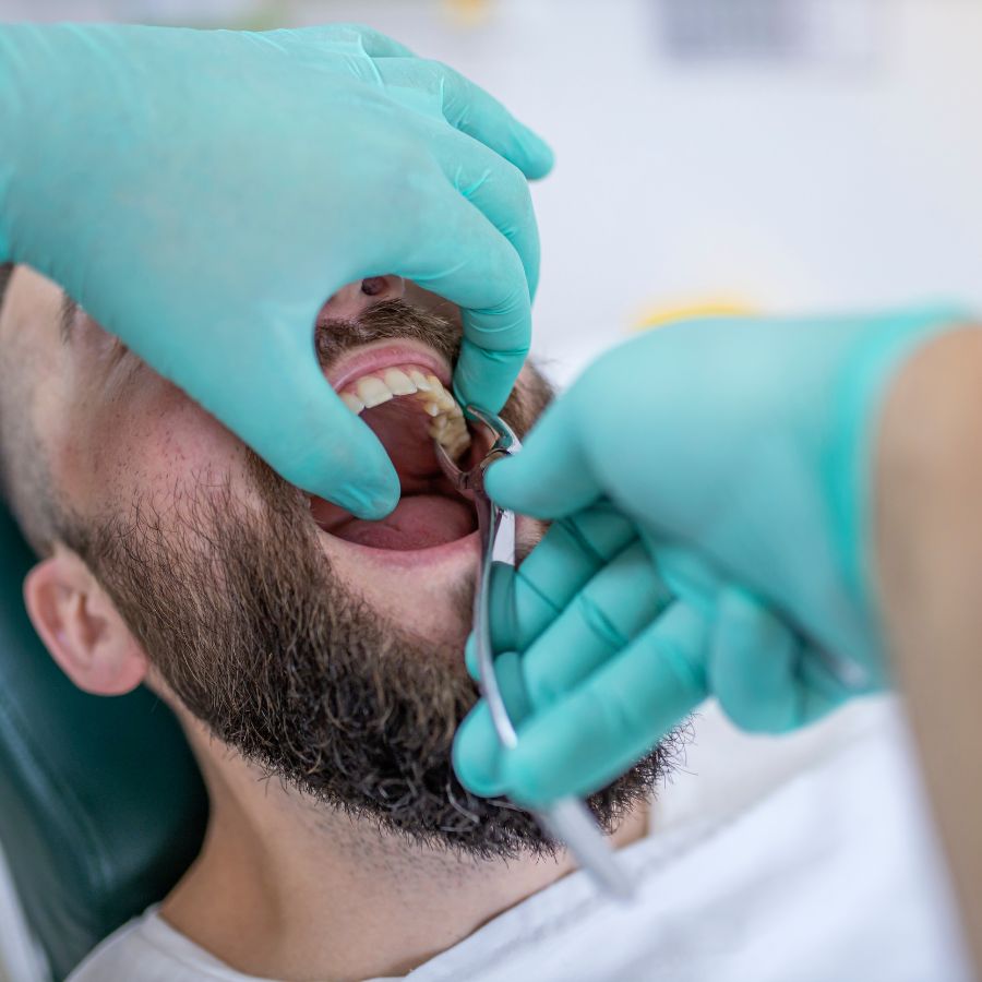 Dental extractions are typically categorized into two types: simple and surgical.