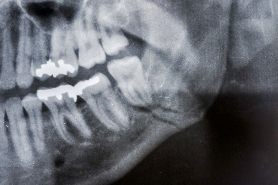 At ROC Dental Group, we specialize in TMJ and headache therapy, providing relief and cultivating well-being for our patients.