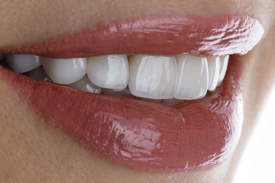 At ROC Dental Group, we're experts in transforming smiles with our high-quality porcelain veneers.