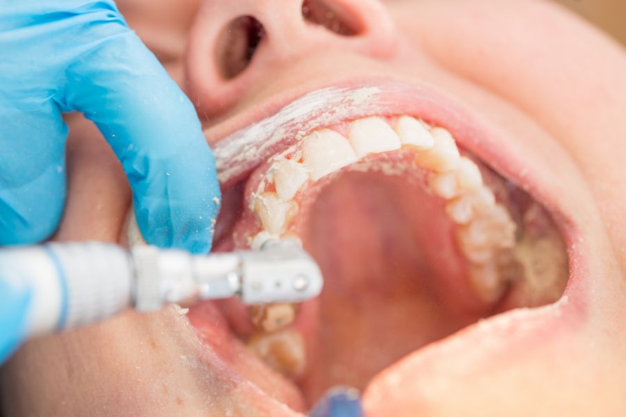 At ROC Dental Group, we're your partners in oral health, offering extensive teeth cleanings and exams.