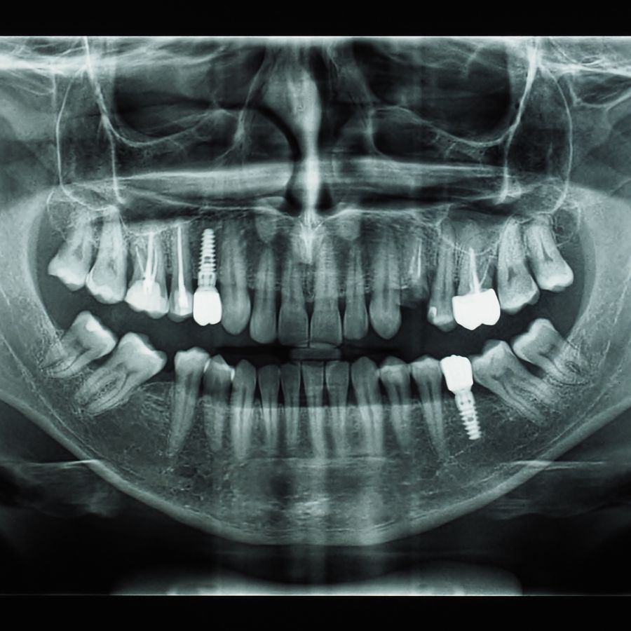 Delving into the process of bone grafting, we find it’s a precise and careful procedure.