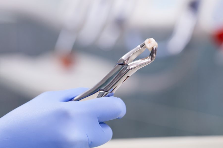 At ROC Dental Group, we excel at providing professional tooth extractions.